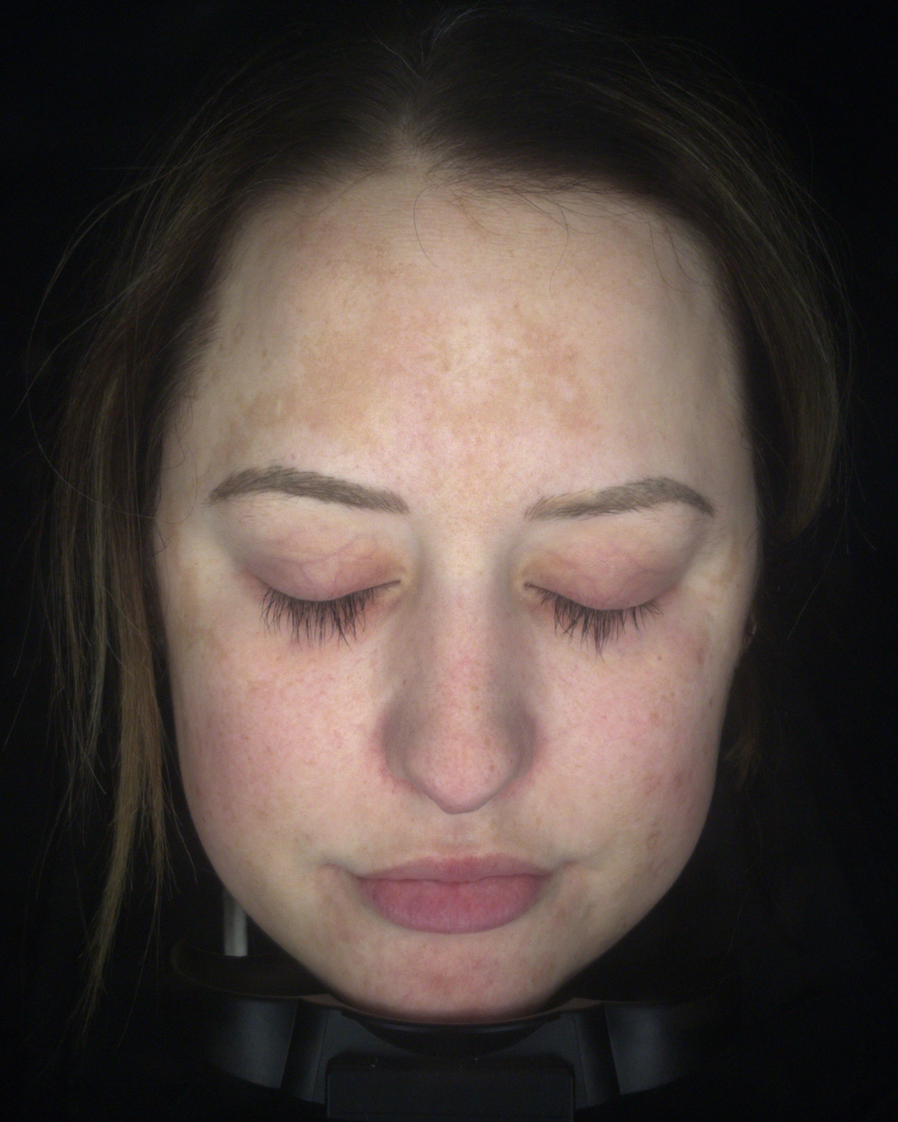 Ragan Skin Transformation Melasma