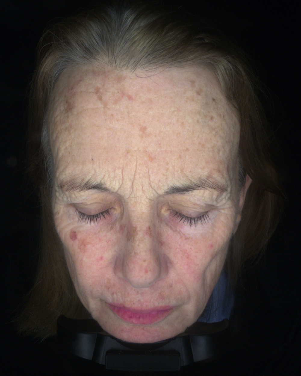 Ragan Skin Transformation Pigmentation