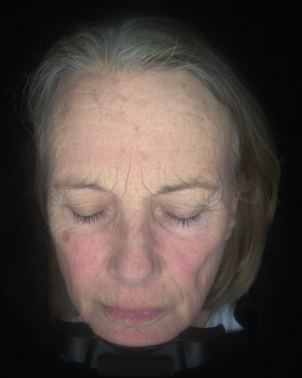 Ragan Skin Transformation Pigmentation